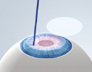 Lasik image 2